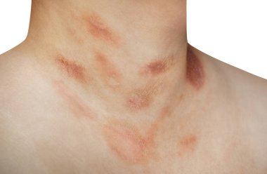 Pityriasis rosea hastalığı göğüs ve boyun izole bir arka plan üzerinde olan bir kişi