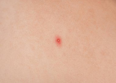 Ten yakın çekim üzerinde büyük kırmızı kabartılar. Güzellik ve Cilt Bakımı.