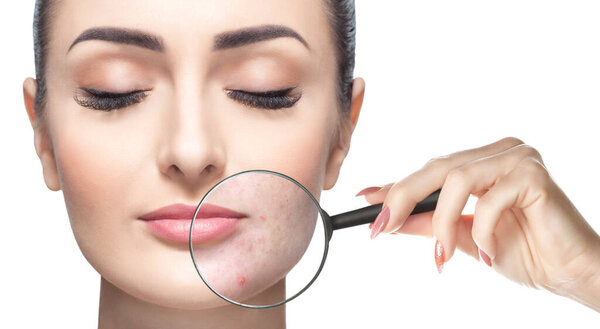 Женщина держит увеличительное стекло рядом с лицом и показывает проблемную кожу. Фото до и после лечения акне.