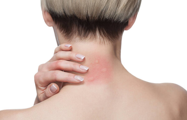 Girl with blond hair, sitting with his back turned and scratching bitten, red, swollen neck skin from mosquito bites in the summer in the forest.  Close-up up of visible insect bites. Irritated skin.