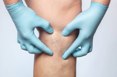 Doktor, bacağındaki küçük kan damarlarının genişlediğini gösteriyor. Telangiectasia ve kozmetolojinin tıbbi denetimi ve tedavisi