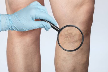 Doktor, bacağındaki küçük kan damarlarının genişlediğini gösteriyor. Telangiectasia ve kozmetolojinin tıbbi denetimi ve tedavisi