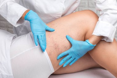 Doktor, bacağındaki küçük kan damarlarının genişlediğini gösteriyor. Telangiectasia 'nın tıbbi muayenesi ve tedavisi. Phlebeurysm.