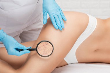 Doktor, bacağındaki küçük kan damarlarının genişlediğini gösteriyor. Telangiectasia 'nın tıbbi muayenesi ve tedavisi. Phlebeurysm.
