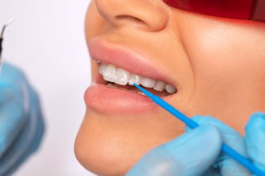 Dişçi klinikte genç ve güzel bir kadına diş beyazlatma prosedürü uyguluyor. Sağlıklı bir gülümseme.