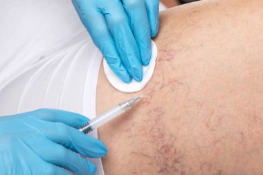 Bacaklardaki varisli damarların çıkarılması. Telangiectasia 'nın tıbbi muayenesi ve tedavisi. Phlebeurysm.
