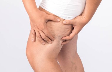 Bir adam bacaklarında selülit, kilo verme konsepti ve sağlıklı bir yaşam tarzı gösterir..