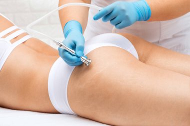 Bir güzellik uzmanı, genç bir kadının kalçasındaki çatlakları temizlemek için mikro cilt bakımı prosedürü uygular..