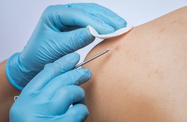 Bir dermatolog bir gencin sırtındaki ve omuzlarındaki sivilceleri temizler..