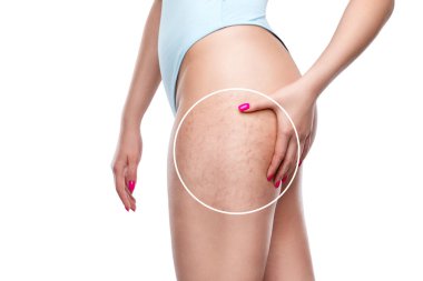 Kilo verdikten sonra bir kadın bacaklarının derisinde ve kalçalarının iç ve dış tarafında gerilme izleri gösterir. Klinikte cilt gerilme izlerinin tedavisi.