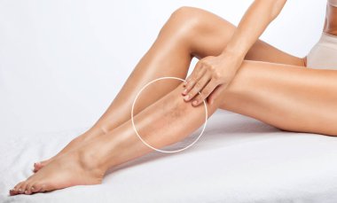 The woman shows the dilation of small blood vessels of the skin on the leg. Medical inspection and treatment of Telangiectasia. Phlebeurysm. clipart
