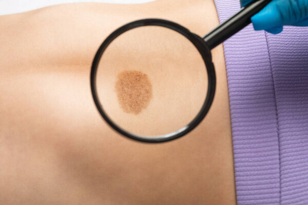 On the woman's stomach, the doctor examines the problem area of the skin with a large mole.