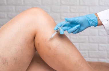 Bacaklardaki varisli damarların çıkarılması. Telangiectasia 'nın tıbbi muayenesi ve tedavisi. Phlebeurysm.sclerotherapy