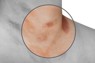 Pityriasis rosea hastalığı göğüs ve boyun izole bir arka plan üzerinde olan bir kişi