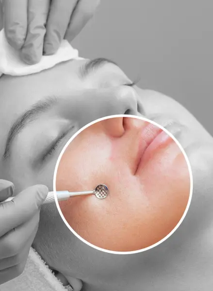 stock image Procedure for cleaning the skin of the face with a steel appliance with a spoon from blackheads and acne.