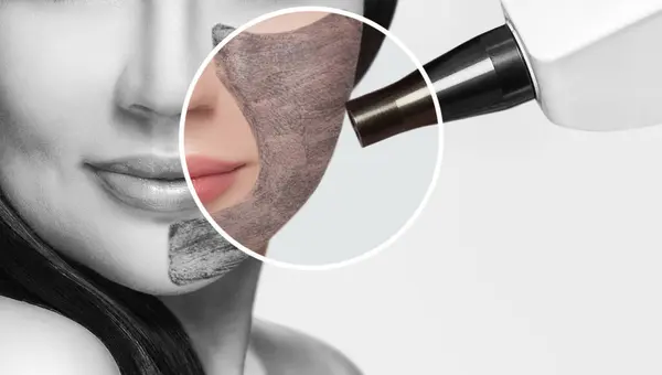 stock image Carbon face peeling procedure in a beauty salon. Hardware cosmetology treatment.