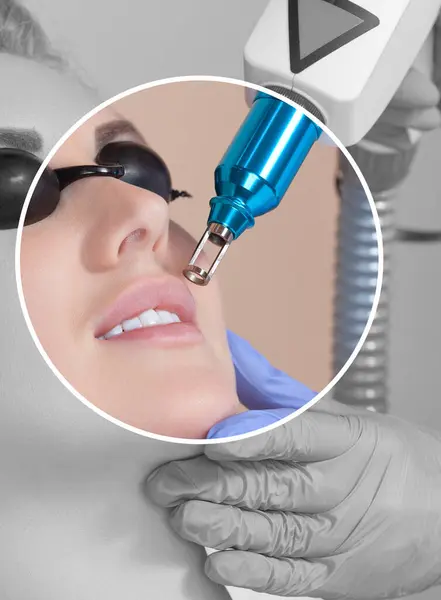 stock image Carbon face peeling procedure in a beauty salon. Hardware cosmetology treatment.