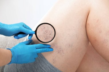 doctor shows  the dilation of small blood vessels of the skin on the leg. Medical inspection and treatment of Telangiectasia. sclerotherapy procedure clipart