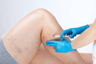 Doktor, bacağındaki küçük kan damarlarının genişlediğini gösteriyor. Telangiectasia 'nın tıbbi muayenesi ve tedavisi. Skleroterapi prosedürü