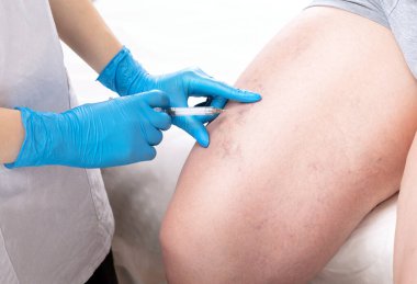 Doktor, bacağındaki küçük kan damarlarının genişlediğini gösteriyor. Telangiectasia 'nın tıbbi muayenesi ve tedavisi. Skleroterapi prosedürü