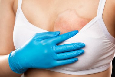 Bir kadın göğsünde yanık izi gösterir. Yandıktan sonra derisini kaynar suyla iyileştirir. Yanıktan etkilenmiş deride pigmentasyon var..