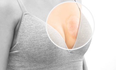 Bir kadın göğsünde yanık izi gösterir. Yandıktan sonra derisini kaynar suyla iyileştirir. Yanıktan etkilenmiş deride pigmentasyon var..