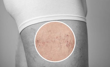 the dilation of small blood vessels of the skin on the leg. Medical inspection and treatment of Telangiectasia. clipart