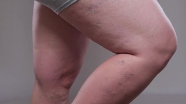 Bacaklardaki varisli damarların çıkarılması. Telangiectasia 'nın tıbbi muayenesi ve tedavisi. Phlebeurysm.sclerotherapy