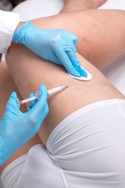 Doktor, bacağındaki küçük kan damarlarının genişlediğini gösteriyor. Telangiectasia 'nın tıbbi muayenesi ve tedavisi. Skleroterapi prosedürü