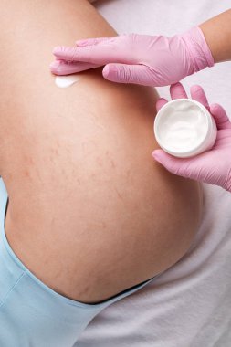 Bacaklardaki varisli damarların çıkarılması. Telangiectasia 'nın tıbbi muayenesi ve tedavisi. Phlebeurysm.