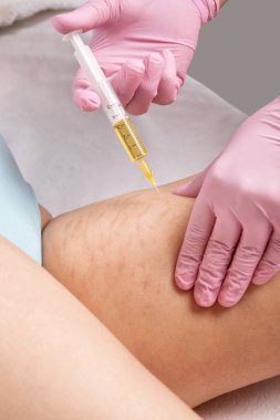 Güzellik uzmanı bir kadının kalçalarına kan plazması enjekte eder. Klinikte cilt gerilme izlerinin tedavisi.