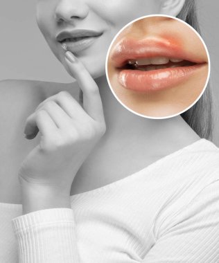 Dudaklarında uçuk hastalığı olan bir kadın. Viral enfeksiyonların tedavisi.