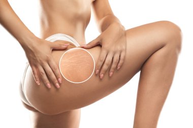 Kilo verdikten sonra bir kadın bacaklarının derisinde ve kalçalarının iç ve dış tarafında gerilme izleri gösterir. Klinikte cilt gerilme izlerinin tedavisi.