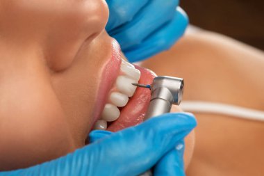 Diş hekimi, dişçi kliniğinde genç ve güzel bir kadının dişlerini tedavi eder. Diş dolgusu.