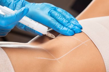 Estetik kozmetik uzmanı bir kadının vücudunda yağ yakmak için lipolitik enjeksiyon yapar. Güzellik salonunda kadın estetiği. Kozmetoloji konsepti..