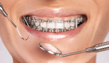 Diş hekiminde genç ve güzel bir kadının dişlerindeki diş tellerini inceleyen bir diş hekimi. Maloklasyonun düzeltilmesi.