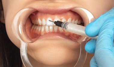 Dişçi klinikte genç ve güzel bir kadına diş beyazlatma prosedürü uyguluyor. Sağlıklı bir gülümseme.