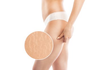 Kilo verdikten sonra bir kadın bacaklarının derisinde ve kalçalarının iç ve dış tarafında gerilme izleri gösterir. Klinikte cilt gerilme izlerinin tedavisi.