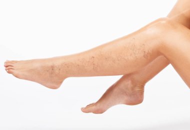 Güzel, ince bir kadın kaplıca salonundaki kanepede oturuyor. Bacağının alt kısmında varis damarları var. Varis ve kılcal damarların tedavisi..