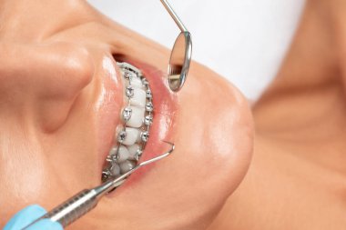 Diş hekiminde genç ve güzel bir kadının dişlerindeki diş tellerini inceleyen bir diş hekimi. Maloklasyonun düzeltilmesi.