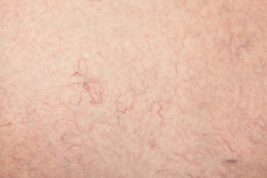 Doktor, bacağındaki küçük kan damarlarının genişlediğini gösteriyor. Telangiectasia 'nın tıbbi denetimi ve tedavisi.