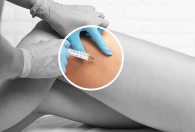 Güzel, ince bir kadın kaplıca salonundaki kanepede oturuyor. Bacağının alt kısmında varis damarları var. Varis ve kılcal damarların tedavisi..