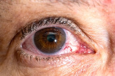 Kırmızı iltihaplı ve genişlemiş kılcal damarları olan bir kadın gözünün yakın çekimi. Kan damarı. Gemi patladı..