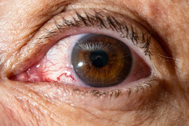 Close-up of  female eye with red inflamed and dilated capillaries. Blood vessel. The vessel burst.
