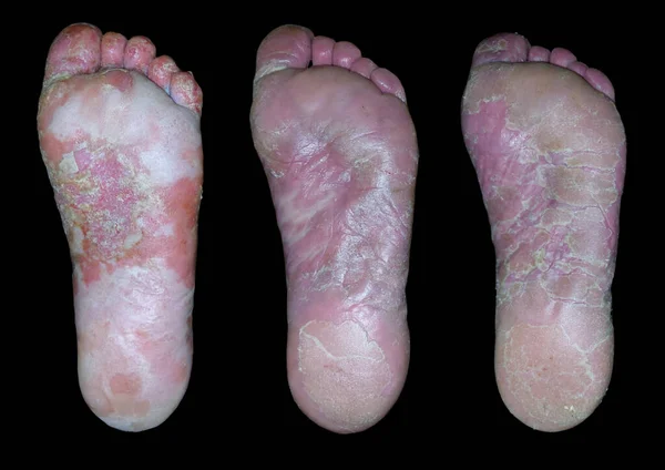 3枚の写真でアレルギー性皮膚疾患の治療 黒の背景 ストック画像