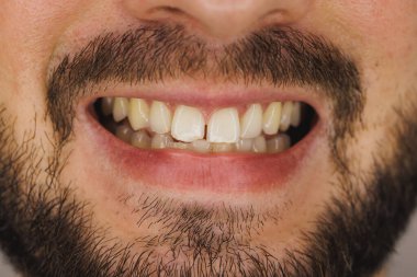 Diş hekimliği veya diş hekimliği yaptırmadan önce dişleriyle gülümseyen tanınmamış bir adamın fotoğrafı..