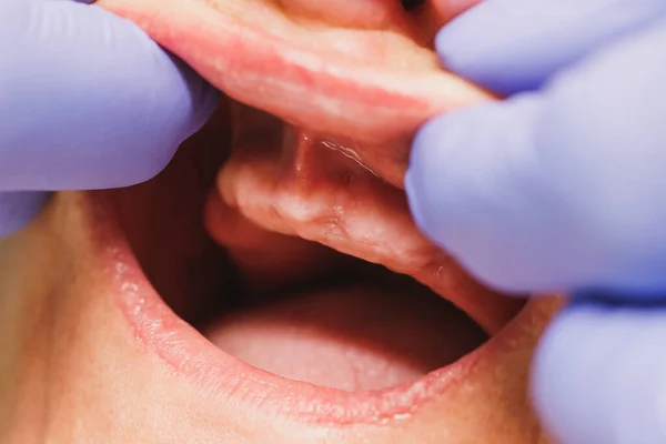 Detailní Záběr Nerozpoznatelného Pacienta Chybějícími Zuby Připravujícího Implantaci Zubů Zubní — Stock fotografie