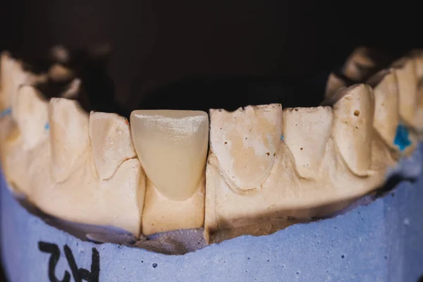 Close-up of an artificial metal free ceramic dental crown on a plaster model. The work of a dental technician.