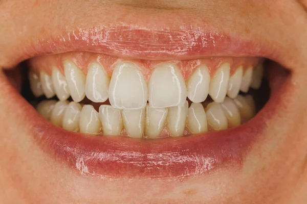 Strzał Nierozpoznawalnej Kobiety Uśmiechającej Się Jasno Zębami Przed Wykonaniem Ortodonty — Zdjęcie stockowe