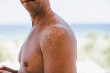 Close-up of a man's shoulder with sunburn. The skin sloughs off its his burn skin. It is the cause of melanoma.